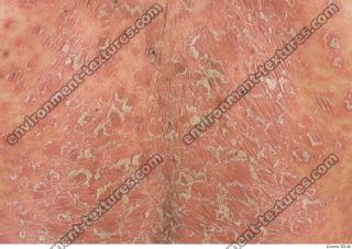 photo texture of scarred skin 0002